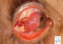 Carcinoma epidermoide