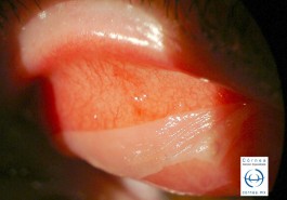Conjuntivitis pseudomembranosa