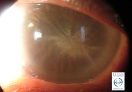 Defecto epitelial en paciente con diabetes mellitus