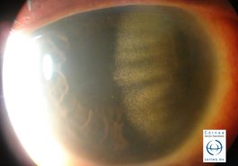 Depósitos de colesterol secundario a neovascularización corneal