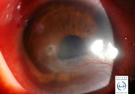 Flictenulosis corneal