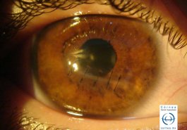 Herida corneal suturada