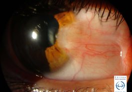 Pterigión nasal