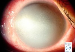 Quemadura corneal por alcali