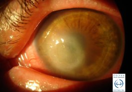 Queratitis bacteriana