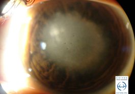 Queratitis estromal disciforme por herpes simple