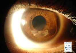 Queratitis herpética estromal no necrotizante