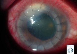 Queratitis infecciosa después de trasplante de córnea
