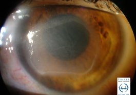 Queratitis neurotrofica