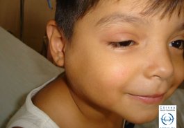 Sindrome oculo glandular de Parinaud