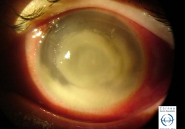 Úlcera corneal por pseudomonas aeroginosa