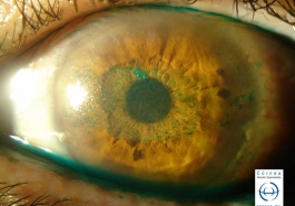 Úlcera corneal teñida con verde de lisamina
