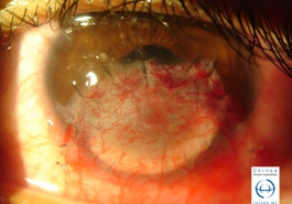 Perforación corneal - Después del injerto corneoescleral, se realiza sobre el un recubrimiento conjuntival