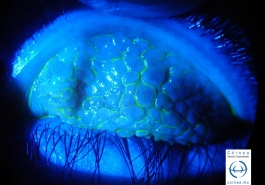 Conjuntivitis papilar gigante vista con luz libre de rojo y con tincion de fluoresceina