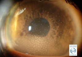 Depósitos retroqueraticos en grasa de carnero secundarios a toxoplasmosis ocular