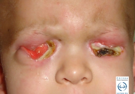 Fascitis necrotizante en infante con leucemia