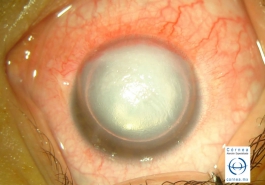 Hidrops corneal tratado con burbuja de perfluoro propano C3F8