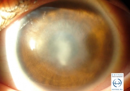 Leucoma corneal