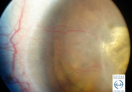 Neovascularización corneal con depósitos de lípidos