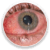 conjuntivitis