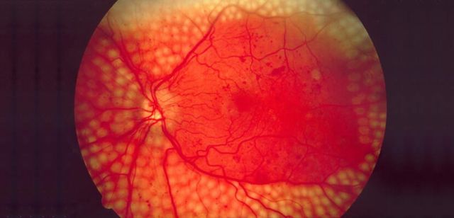 discos-opticos-glaucomatosos