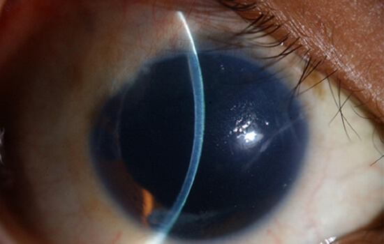 edema-corneal