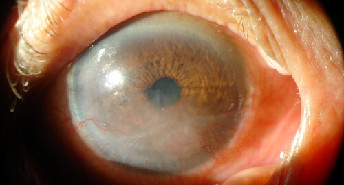 rosacea_cornea