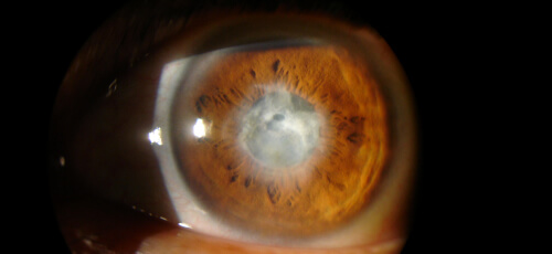 ulcera_corneal_1_cornea