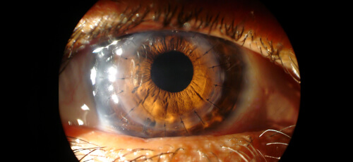 ulcera_corneal_2_cornea