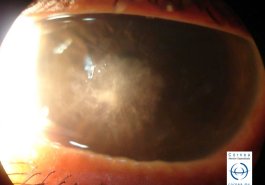Úlcera corneal micótica