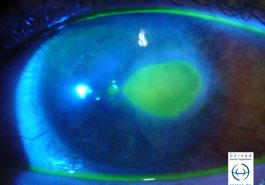 Úlcera corneal teñida con fluoresceina