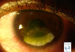 Perforación corneal - Parche esclero corneal