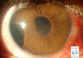 Dialisis de iris postraumatica con edema corneal