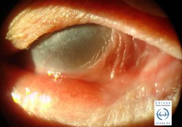Epidermalización-de-la-superficie-ocular-en-penfigoide-ocular
