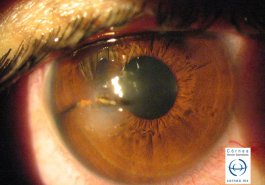 Herida corneal penetrante por cuerpo extraño metálico