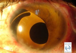 Lente intraocular con protesis de iris