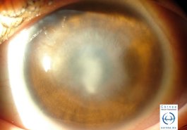 Leucoma corneal
