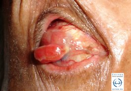 Melanoma de córnea