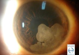 Neoplasia Intraepitelial vista con iluminación