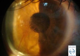 Neovascularización corneal