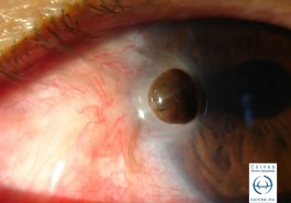 Perforación corneal con exposición de iris después de cirugía de pterigión